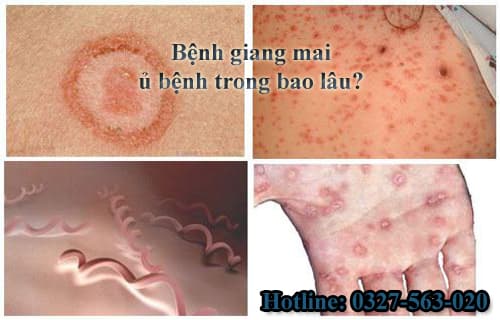 Bệnh giang mai có chữa khỏi dứt điểm được không